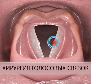 Дауысты қалпына келтіру бойынша операция – дауыс шымылдығының біржақты парезі кезінде инъекциялық ларингопластика