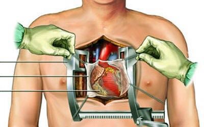 Стандартный доступ к сердцу через стернотомию