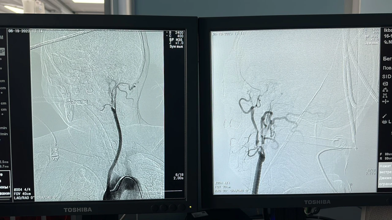 Первая операция, проведенная совместно врачами нейрохирургами и кардиохирургами Больницы МЦ УДП РК, прошла успешно 