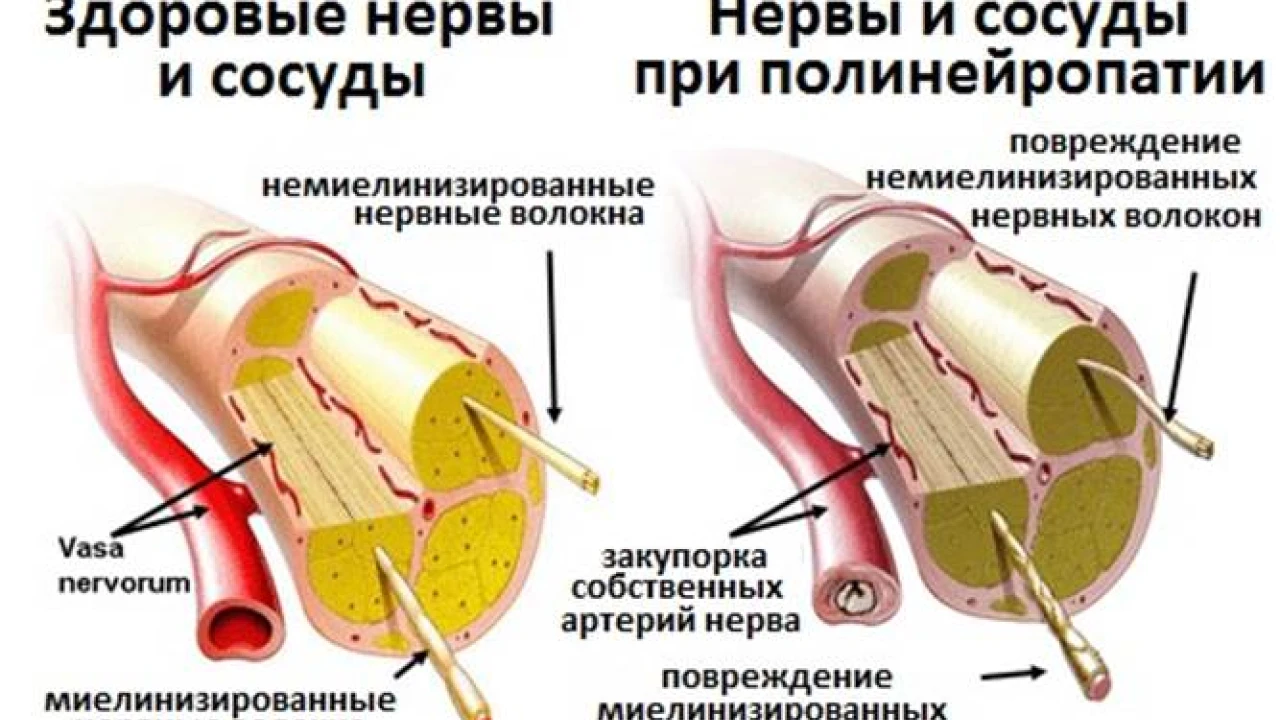 Қазақ популяциясындағы диабеттік нейропатияның кардиоваскулярлық түрі бар кейбір генотиптер қауымдастығын зерттеу 