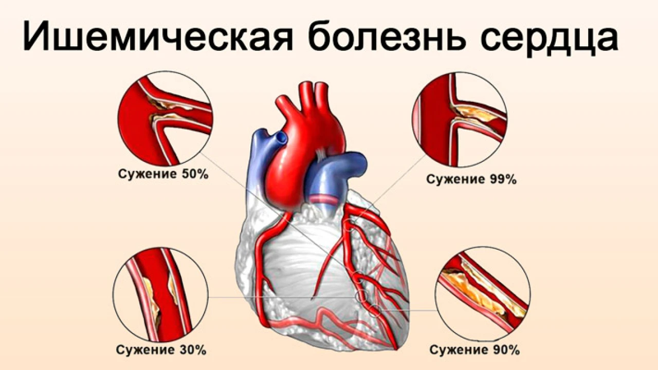 Оценка прогностической ценности структурной вариабельности генома для развития ишемической болезни сердца при сахарном диабете II типа у казахов 